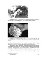 Otosclerosis and Stapes Surgery - part 3 docx