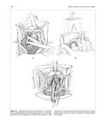 Vaginal Surgery for Incontinence and Prolapse - part 5 pdf