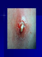 Bài giảng bệnh nhiễm tụ cầu