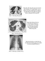 Dấu hiệu một số bệnh phổi thường gặp