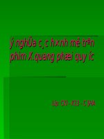 Ý nghĩa các hình mờ trên phim x quang phổi quy ước