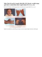 Một số tật di truyền ở người