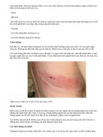 Triệu chứng và các biện pháp điều trị bệnh zona thần kinh