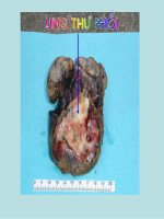 Bài giảng giải phẫu bệnh ung thư phổi