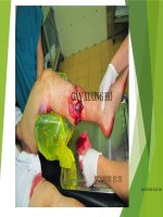 Đại cương gãy xương hở