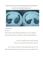 ĐIỀU TRỊ UNG THƯ vú DI căn não BẰNG hóa CHẤT kết hợp với xạ TRỊ và xạ PHẪU DAO GAMMA QUAY