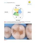 Hướng dẫn chi tiết hàn phục hồi trực tiếp răng 6 trên bằng composite (phần 2)