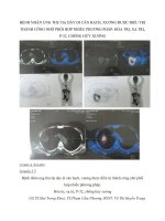 BỆNH NHÂN UNG THƯ dạ dày DI căn HẠCH,XƯƠNG được điều TRỊ THÀNH CÔNG NHỜ PHỐI hợp NHIỀU PHƯƠNG PHÁP hóa TRỊ,XẠ TRỊ