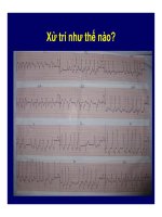 TIỆM CẬN BỆNH NHÂN RỐI LOẠN NHỊP