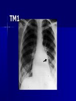 THI CHẨN ĐOÁN HÌNH ẢNH HỆ TIM MẠCH