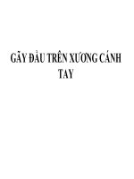Gay dau tren xuong canh tay gãy đầu trên xương cánh tay   ths bs  phạm việt triều