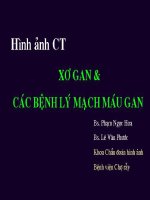 Hình ảnh ct xơ gan và các bệnh lý mạch máu gan 