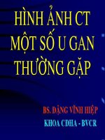 Hình ảnh ct một số u gan thường gặp 