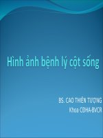 Hinh anh benh ly cot song 175 