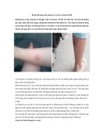 Tải Bí kíp giắt lưng chữa bỏng bô xe máy ai cũng nên biết - Cách chữa bỏng bô xe máy an toàn, không để lại sẹo