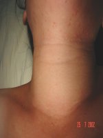 BỆNH u (GIẢI PHẪU BỆNH) (chữ biến dạng do slide dùng font VNI times, tải về xem bình thường) 